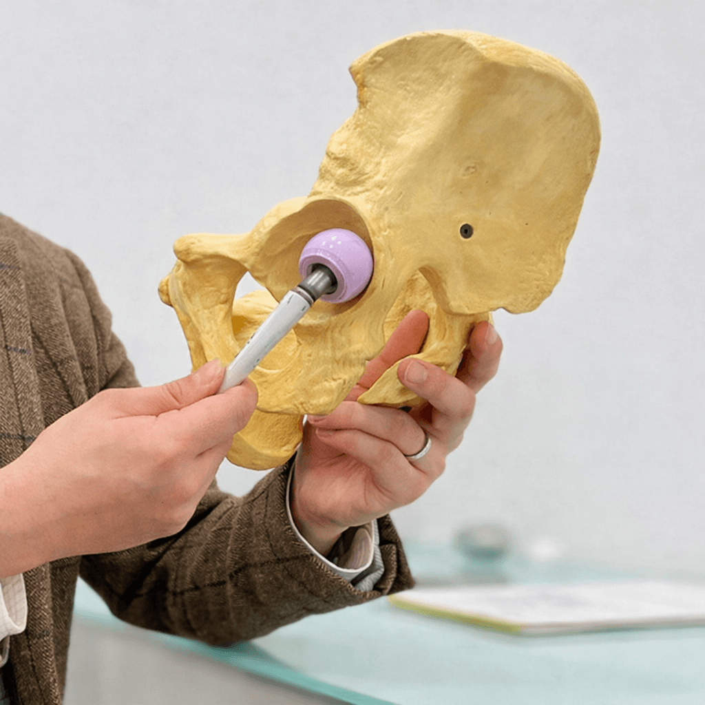 Anatomical pelvis model showing a total hip replacement.